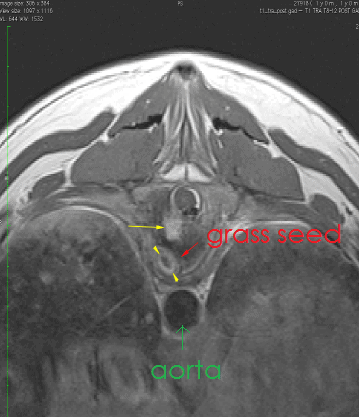 MRI of Alfie's spine