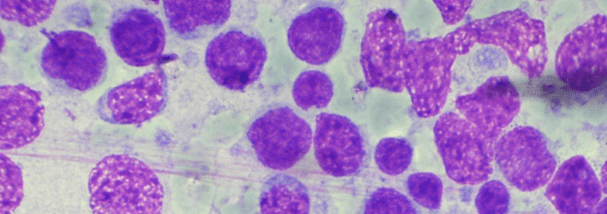 lymphoma-cells